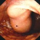 Gastric stromal tumour