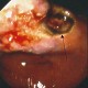 Gastric ulcer at incisura