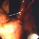 Dieulafoy’s vascular ectasia in stomach with contact bleeding