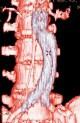 Bifurcated aortic stent graft for infrarenal abdominal aortic aneurysm