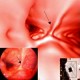 Virtual bronchoscopy: normal carina with rigid bronchoscopy comparison