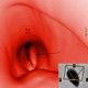 Virtual retrograde bronchoscopy: undersurface of vocal cords