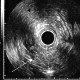 Carcinoma of common hepatic duct (Klatskin tumour)