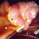 Carcinoma of ampulla of Vater