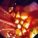 Common bile duct stones dropping into duodenum after sphincterotomy