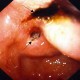Double chronic duodenal ulcers