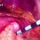 Gastric lymphoma, serosal surface
