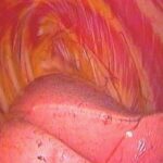 Thoracoscopic view of R hemithorax